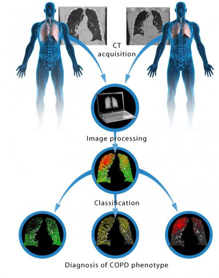 Breathe In, Breathe Out: New Way Of Imaging Lungs Could Improve COPD ...